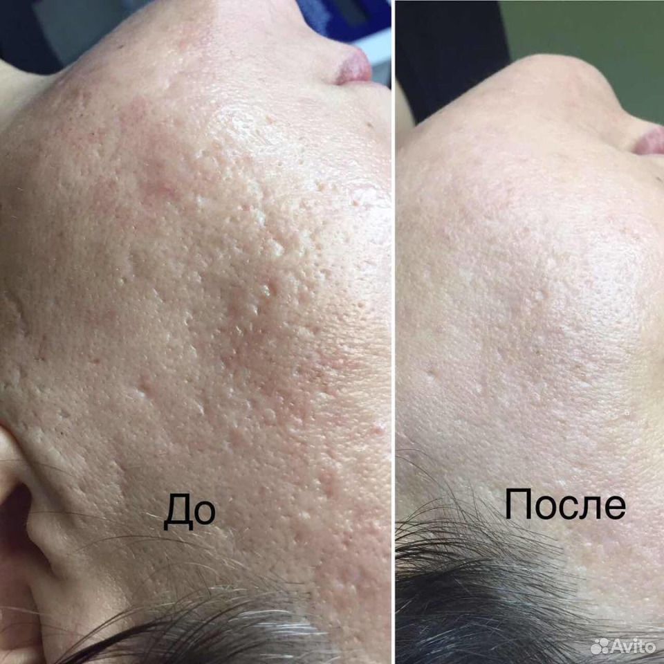 Сгладить Кожу На Фото