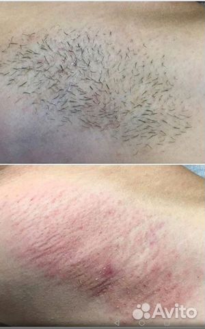 Электроэпиляция Электроэпиляция