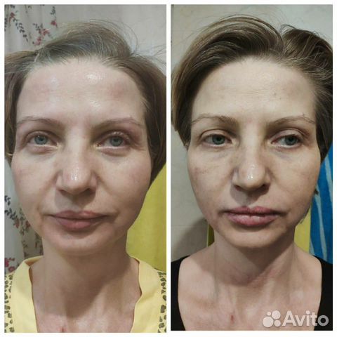 Массаж лица, антицеллюлитный массаж,коррекция фигу