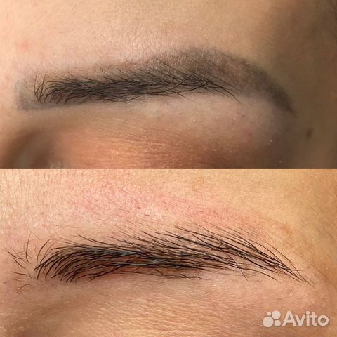 Удаление татуажа и тату