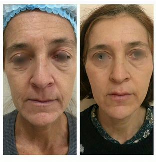 Скидка 50 на нитевой лифтинг. К тренеру моделью